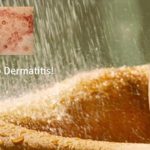 Natural Dermatitis Treatment Remedies
